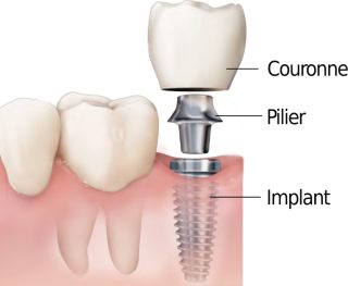 Implant Schéma en vue éclatée d'un implant dentaire