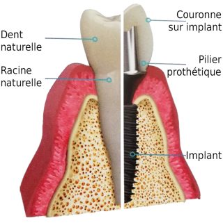 Implant2 Schéma en coupe d'un implant dentaire