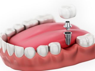 Implant3 https://cabinet-mts.fr/wp-content/uploads/2026/03/Implant3-320x240.jpg