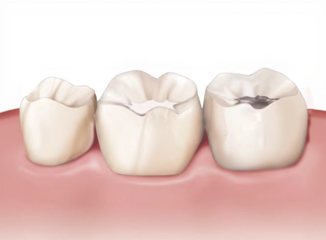 Obturation Obturation