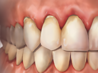 Parodontite Stade III Parodontite Stade III