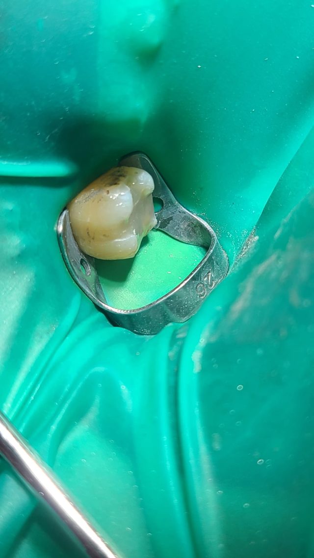 Soin d'une dent Soin d'une dent