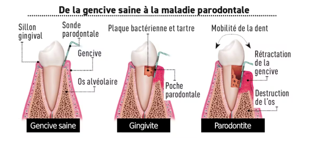 gencive_saine_maladie gencive_saine_maladie