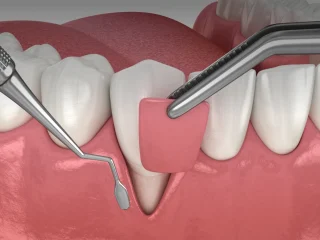 greffe-gingivale greffe-gingivale