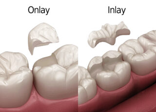 Onlay / Inlay Onlay / Inlay